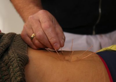 Kangfu Seminars | Needling around the umbilicus